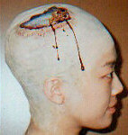bald wound